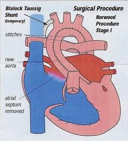 Norwood Procedure copy.jpg